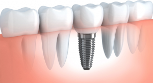 Implantes dentales.