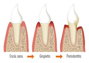 Evolución enfermedad periodontal.